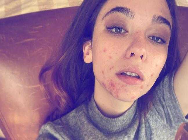 Matilda De Angelis confessione choc soffro di problemi di ansia e di acne