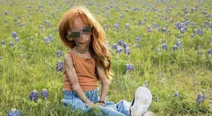 Morta Adalia Rose, youtuber 15enne con la progeria